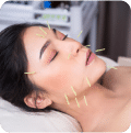 A woman receiving cosmetic acupuncture treatment on her face, showcasing a serene and rejuvenating atmosphere